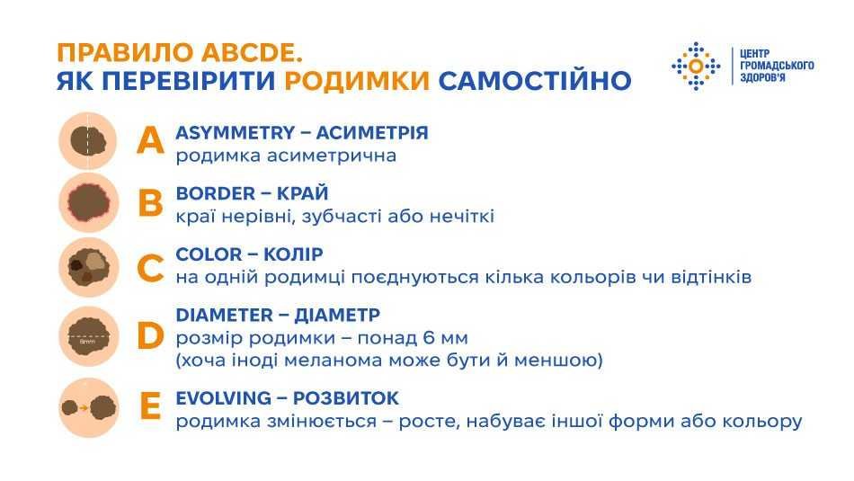Травень — місяць обізнаності про меланому. Як їй можна запобігти та коли звертатися до лікаря